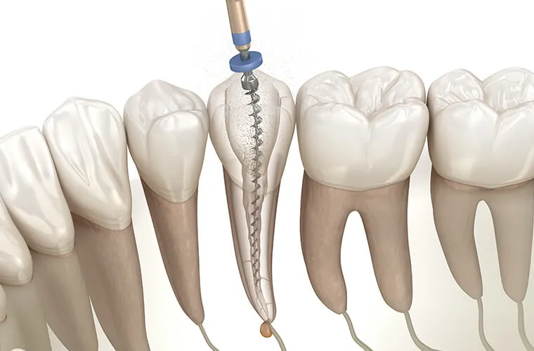 根管治療